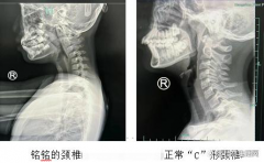 9岁女孩沉迷手机颈椎老如50岁 这病已开始“进攻”小学生